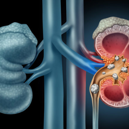 Kidney-Stone-Diagram